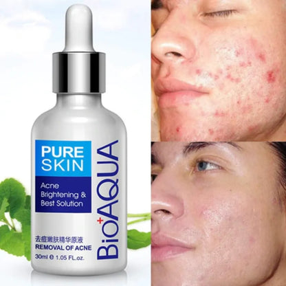 Kit Anti acne Bioaqua